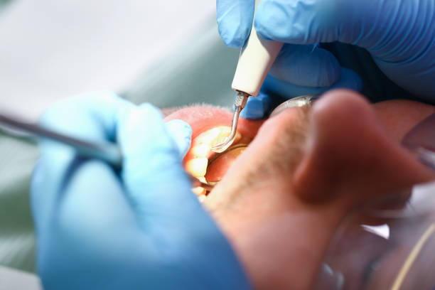 Best Emergency Tooth Extraction in Shattuck, OK
