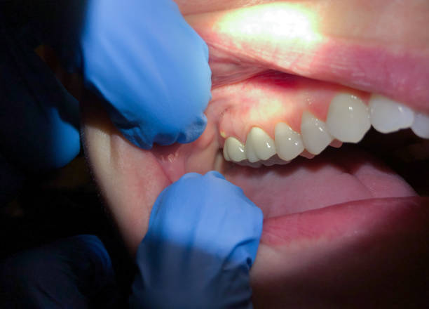 Best Emergency Tooth Extraction in Shattuck, OK