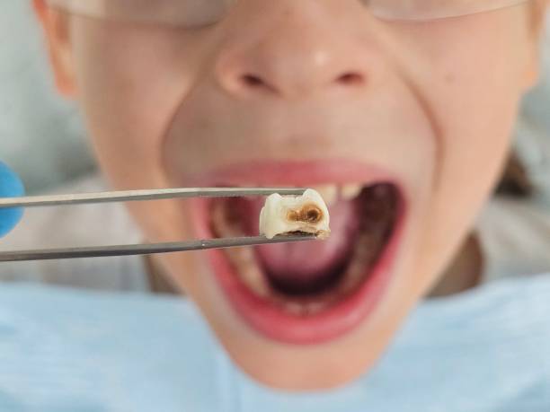Best Emergency Tooth Extraction in Shattuck, OK